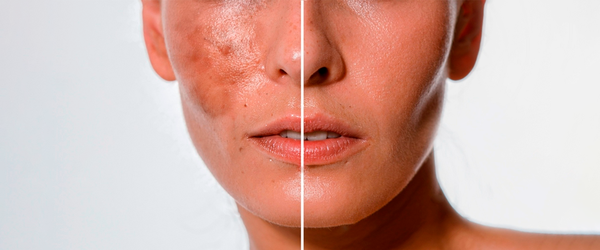 Image showing treatments and solutions for reducing hyperpigmentation and dark spots.