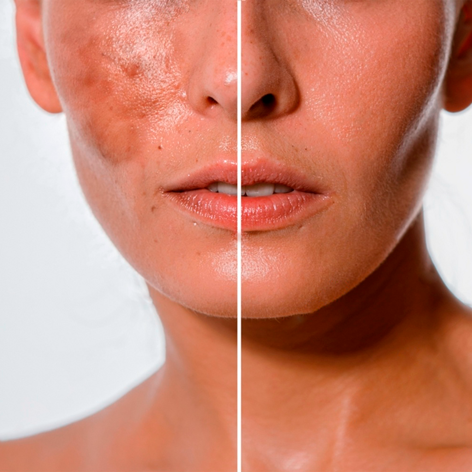 Avoid melasma attacks after summer