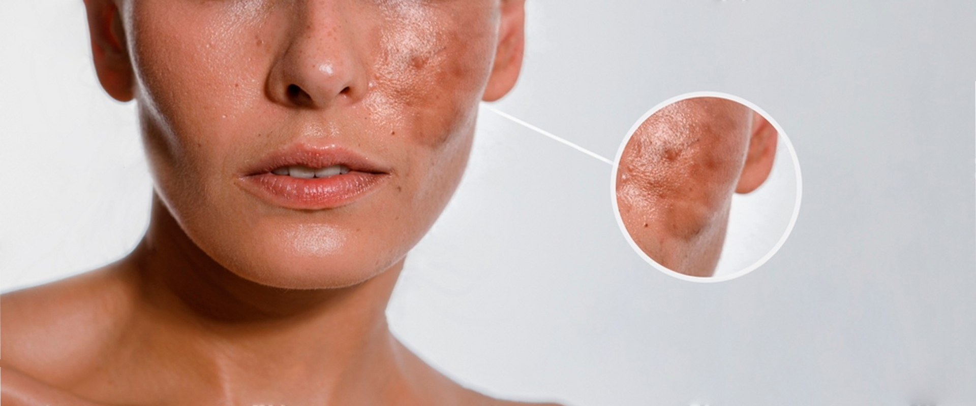 Learn how to address hyperpigmentation with effective skincare strategies. Discover prevention tips and treatment approaches to improve skin tone and reduce dark spots